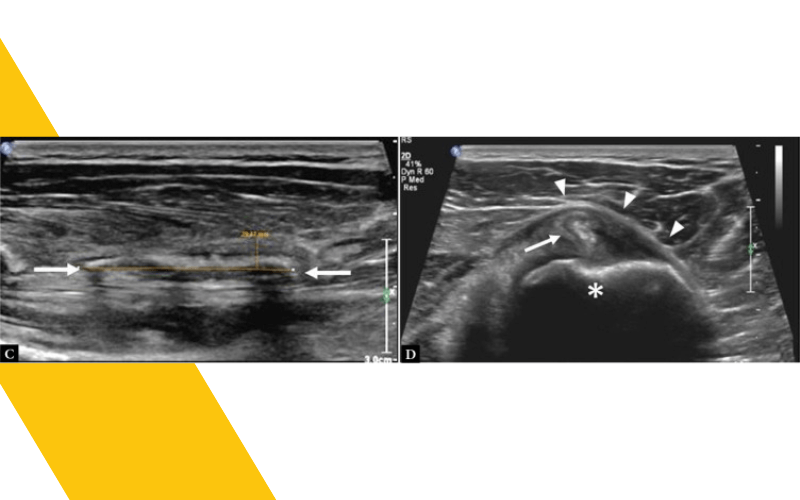 7. Evaluacion lesiones pectoral mayor ecografia tempo formacion.png